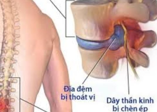 Bệnh thoát vị địa đệm Bệnh thoát vị địa đệm